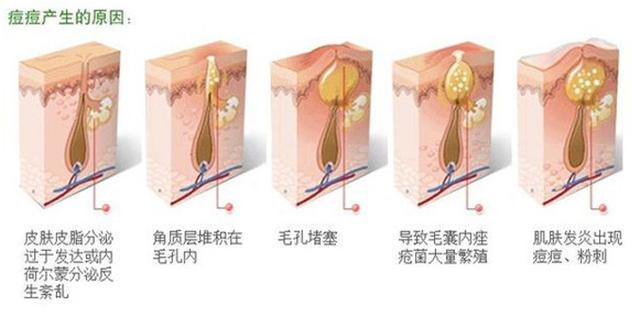 去痘印最快的方法_痘印怎么去痘印_怎去痘印